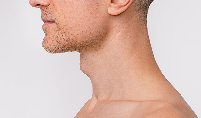 Redução do Pomo de Adão